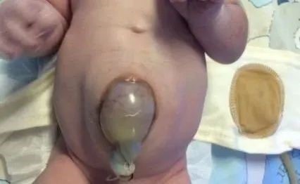 胎监提示反应型,3 小时后胎心突然消失,胎死宫内! 胎监提示反应型,3 小时后胎心突然消失,胎死宫内!