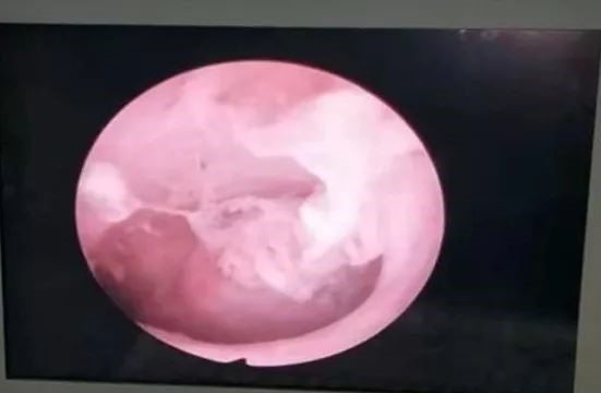 两次清宫术后仍间断出血 11 天,小心这种情况 两次清宫术后仍间断出血 11 天,小心这种情况