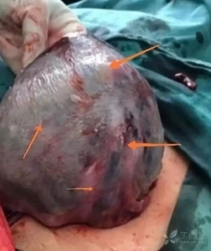 孕 38 周,腹痛 4 小时入院,自以为临产先兆,但却是胎死宫内 孕 38 周,腹痛 4 小时入院,自以为临产先兆,但却是胎死宫内