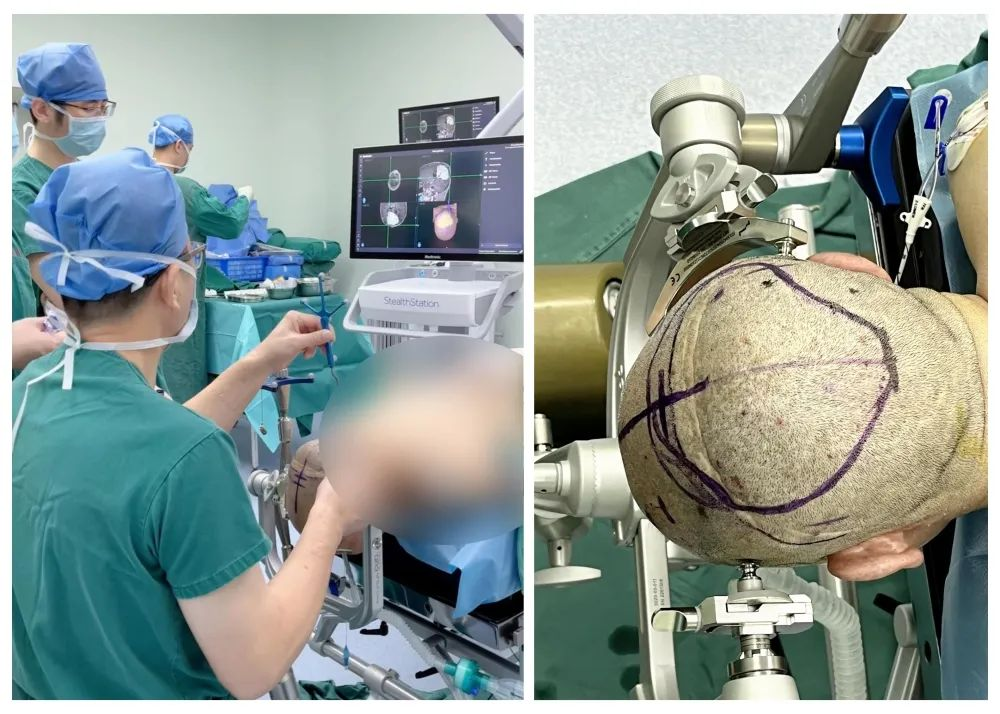 病例分享|金沙洲医院神经导航协助专家开展巨大脑膜瘤手术！