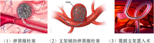 2023年神经介入器械行业市场规模增长率分析及重点企业竞争战略研究预测