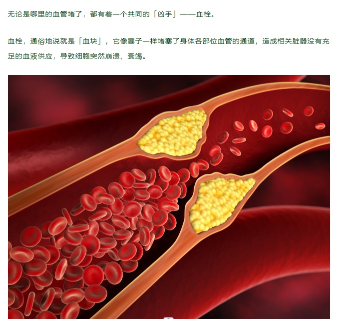 坐 2 小时就可能形成血栓！这 3 个地方痛，就要小心了