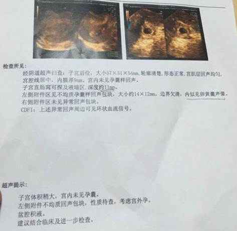 因宫外孕失去输卵管，试管一次成功，分享好孕
