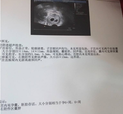 多囊不孕，泰国三代试管婴儿，一次喜获龙凤胎