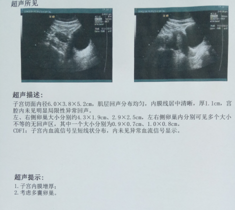 多囊、双胞胎生化，细数5年求子路经历的心酸事情