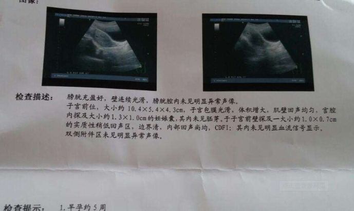 双侧输卵管梗阻，4次试管7次移植，终于和不孕说再见
