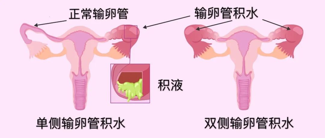 输卵管造影结果的判别误区