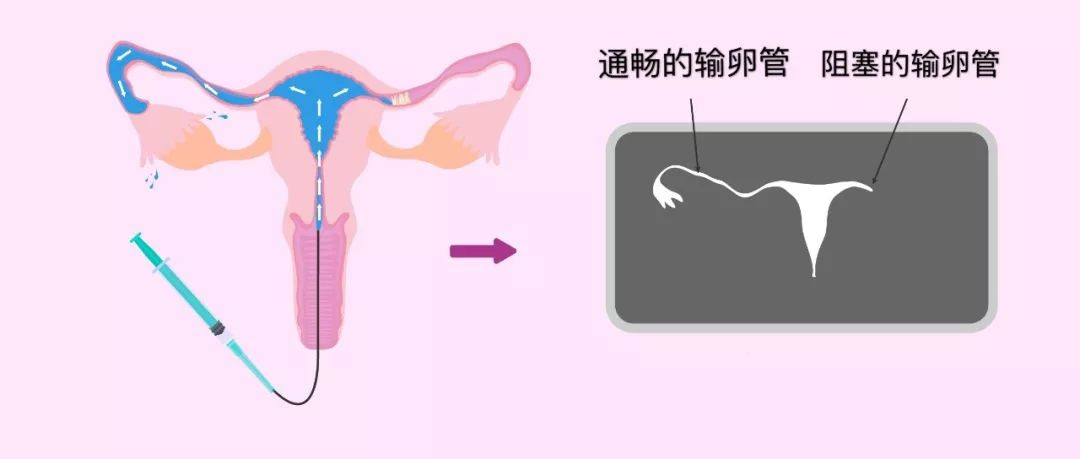 说说更加直观清晰的子宫输卵管4D超声造影