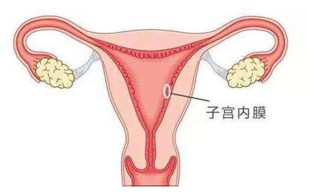 子宫内膜增生的今天观点