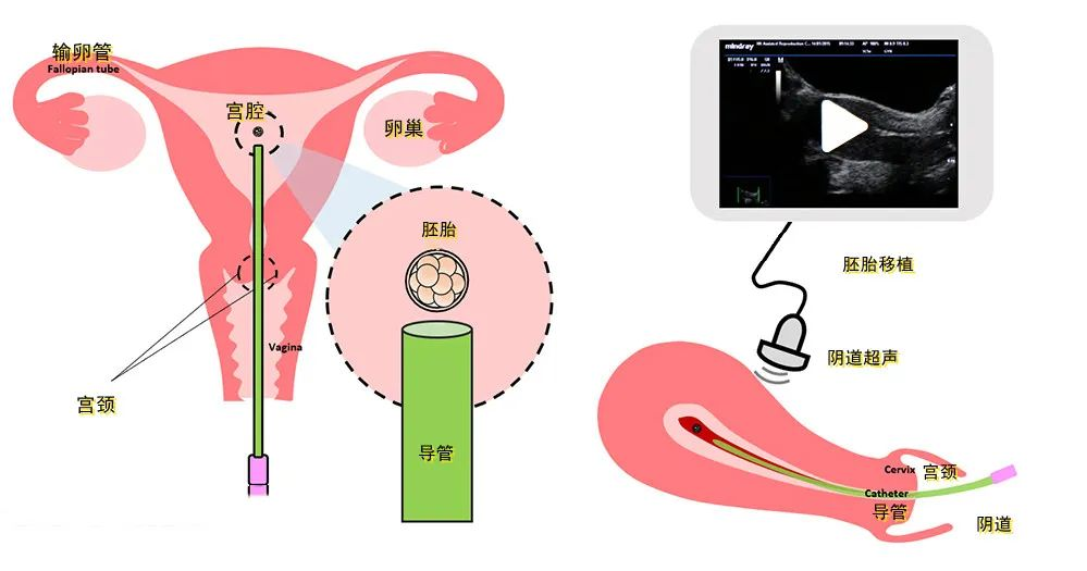 “试管婴儿”冻胚移植的三种方案