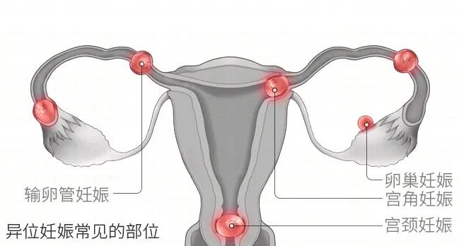 “要命”的宫外孕，最爱找这 7 种人