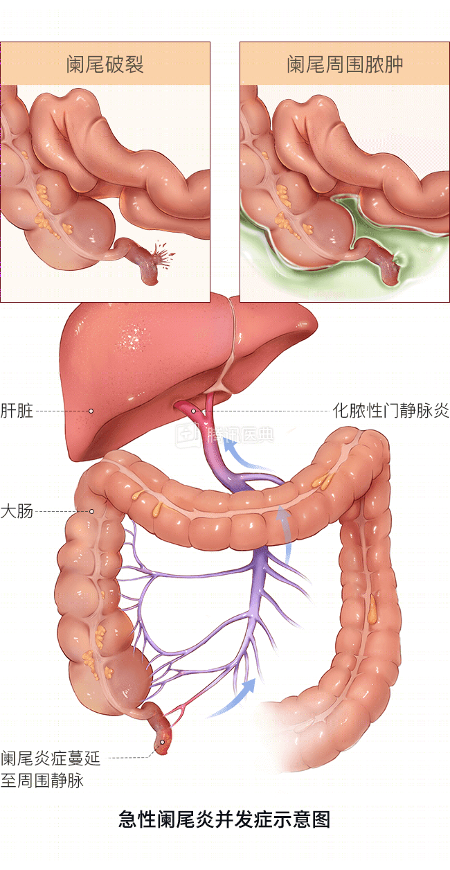 “要命”的宫外孕,最爱找这 7 种人 “要命”的宫外孕,最爱找这 7 种人