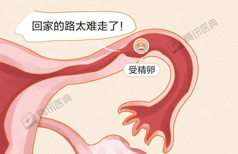 “要命”的宫外孕,最爱找这 7 种人 “要命”的宫外孕,最爱找这 7 种人