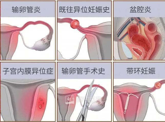 “要命”的宫外孕,最爱找这 7 种人 “要命”的宫外孕,最爱找这 7 种人