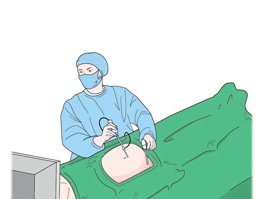 腹腔镜手术二三事