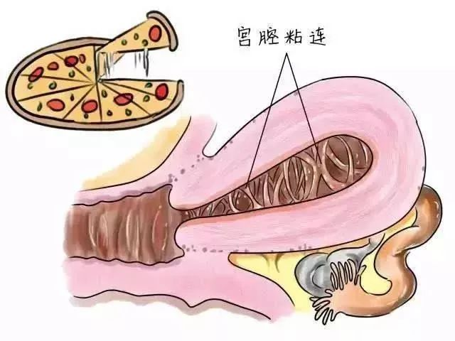 宫腔粘连对怀孕有多少影响？