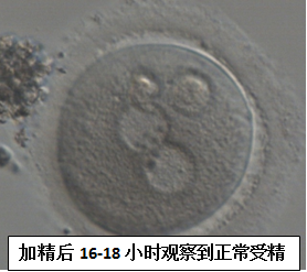 哪些精子问题第二代试管也不行? 哪些精子问题第二代试管也不行?