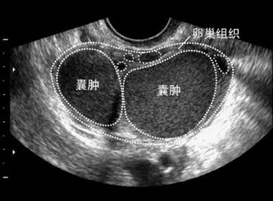 巧克力囊肿的形成及治疗