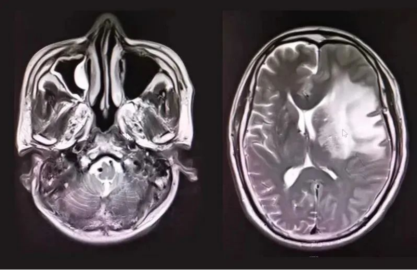 病例分享|金沙洲医院神经导航下开展脑脓肿清除术