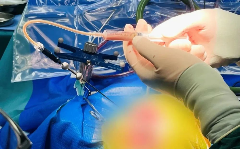 病例分享|金沙洲医院神经导航下开展脑脓肿清除术