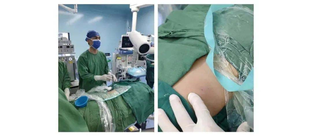 A new force for stone removal | Needle-perc®—the gospel for children with kidney stones A new force for stone removal | Needle-perc®—the gospel for children with kidney stones