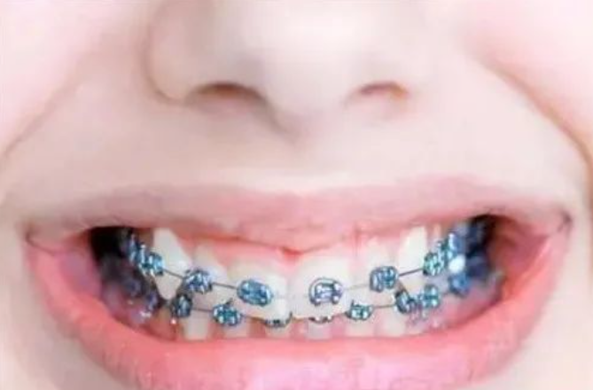 深圳口腔医院专家：牙齿矫正为什么价格差这么多？看完牙套的种类和价格你就知道了