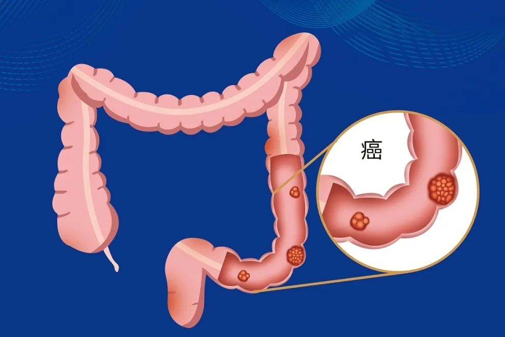 多数肠癌一发现就是晚期！这六类高危人群请尽快早筛
