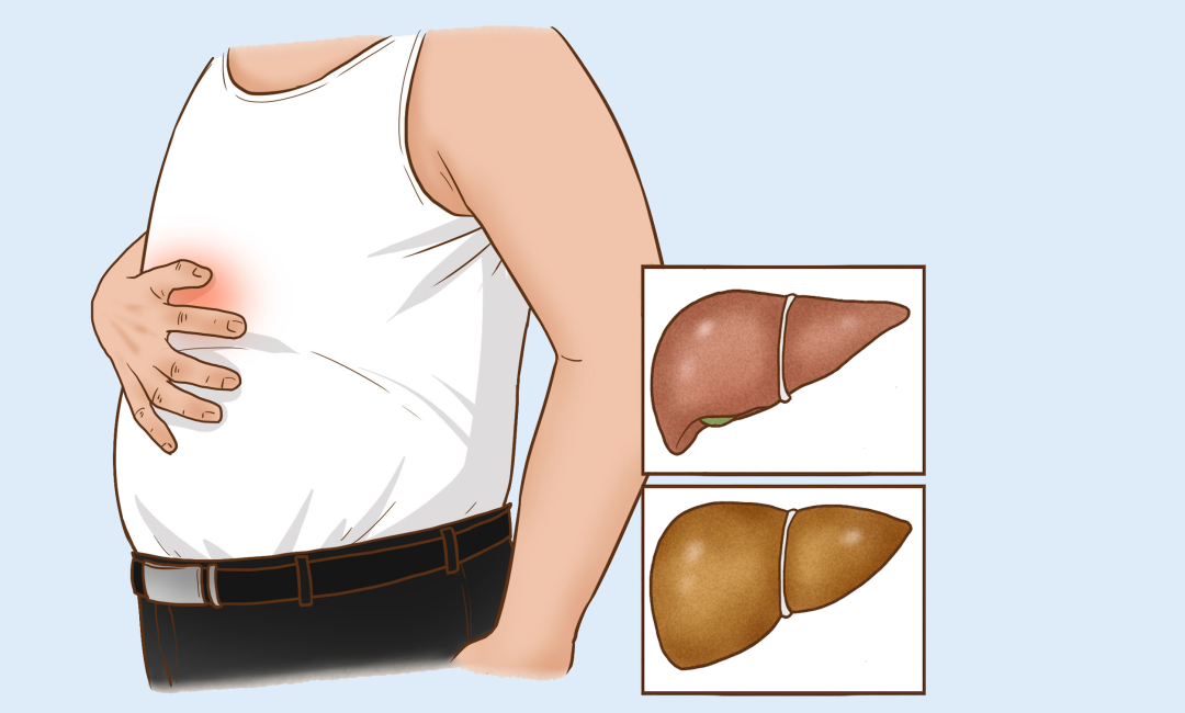 困扰两亿国人！年轻健壮的肝是怎么一步步坏掉的？