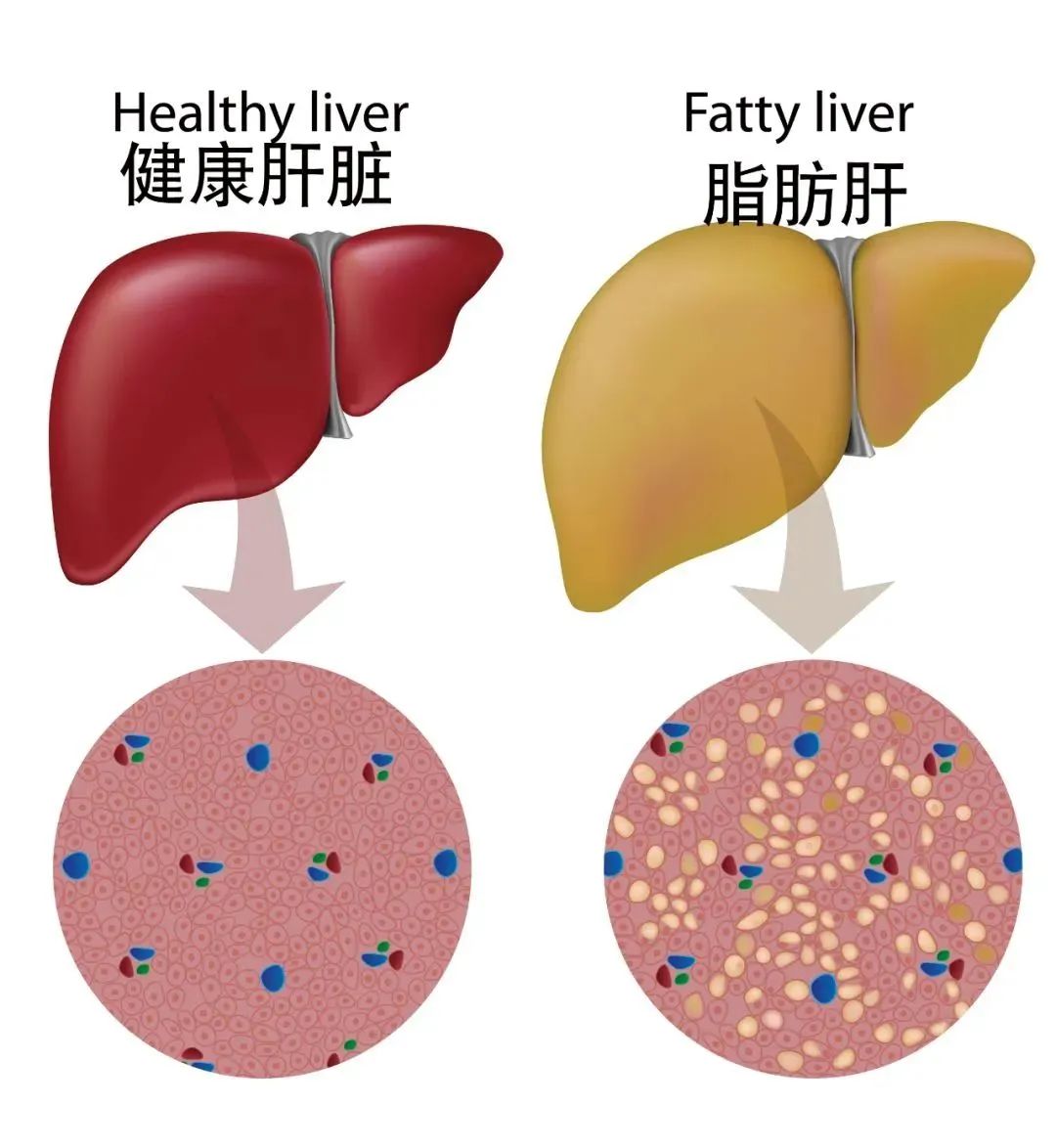 困扰两亿国人！年轻健壮的肝是怎么一步步坏掉的？