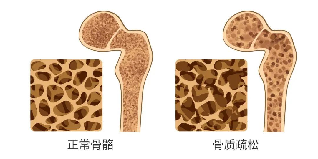 骨质疏松危害被严重低估，这种情况易诱发全身感染！