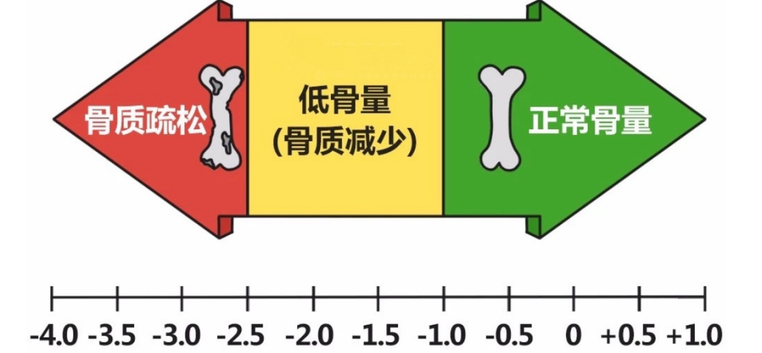 骨质疏松危害被严重低估，这种情况易诱发全身感染！