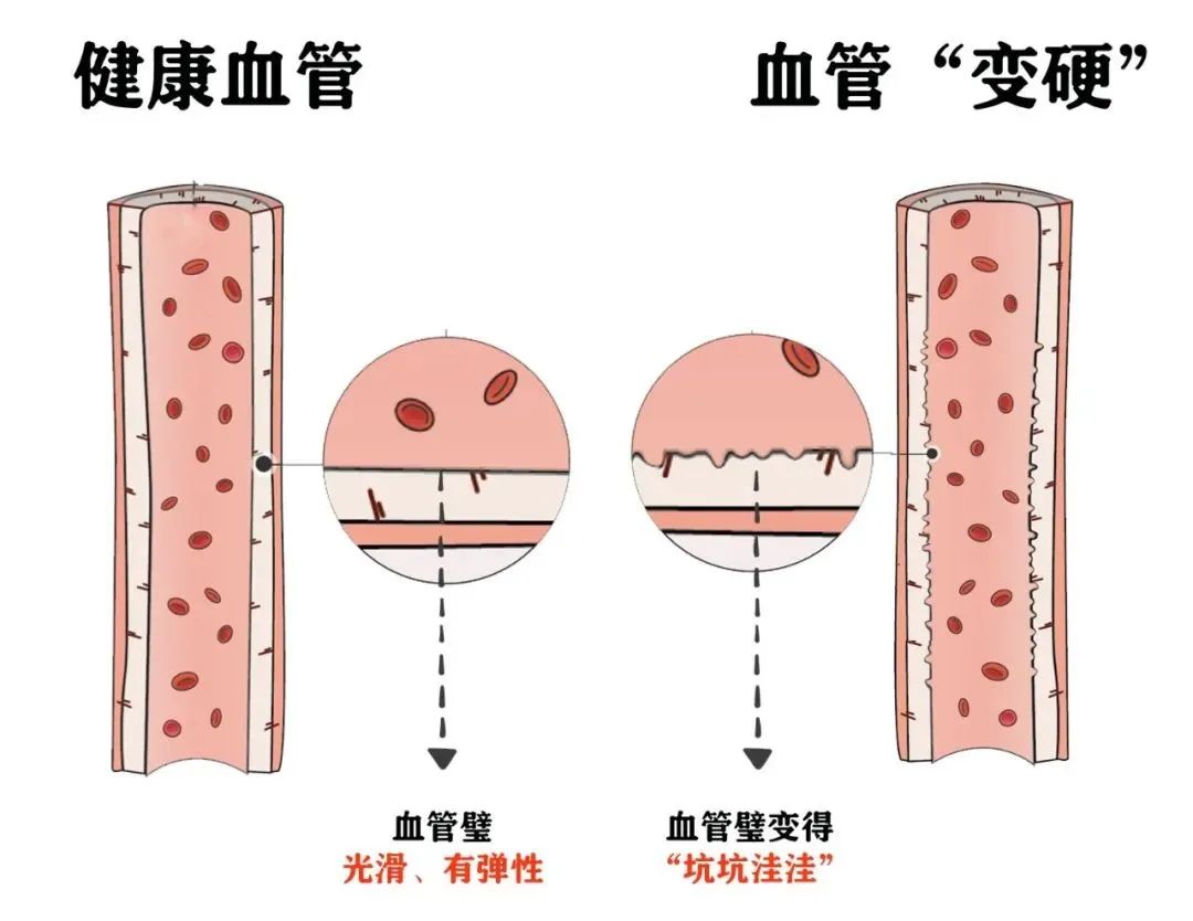 这3个极易忽视的症状，暗示血管正悄悄“长斑变硬”！