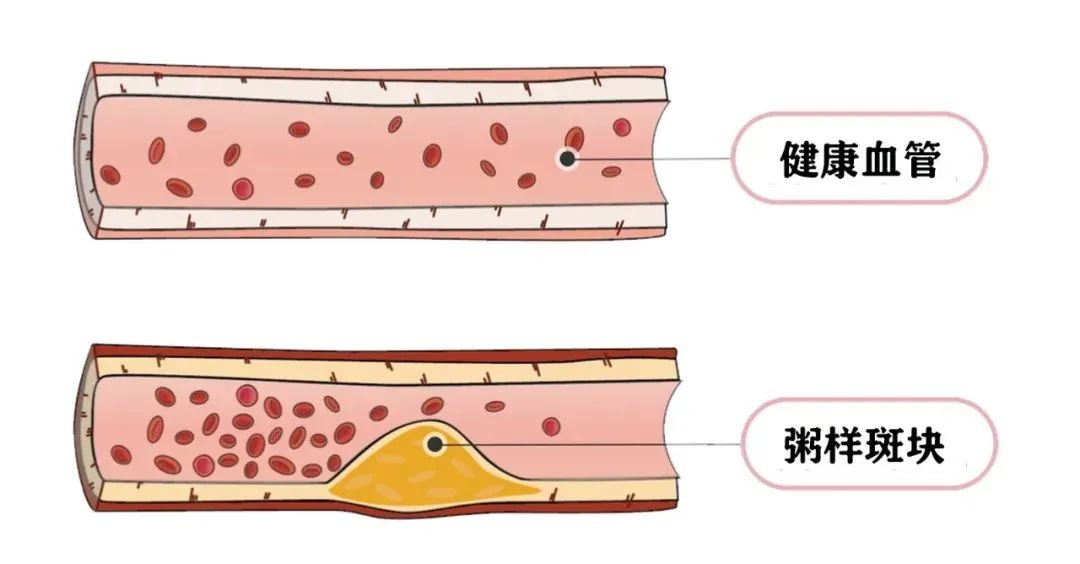 这3个极易忽视的症状，暗示血管正悄悄“长斑变硬”！