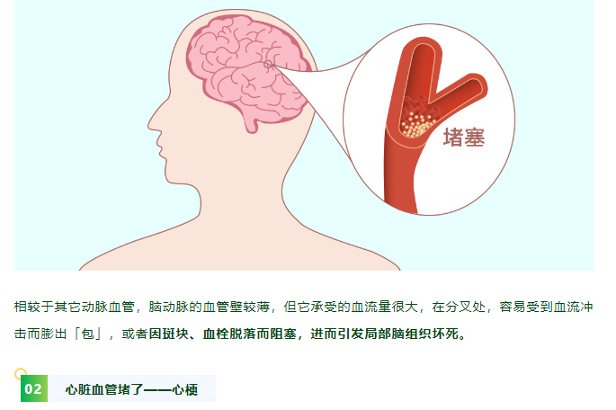 这 3 种习惯，可能是血管堵塞的「元凶」