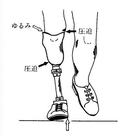 假肢穿戴舒服的三要素：接受腔，对线，康复训练