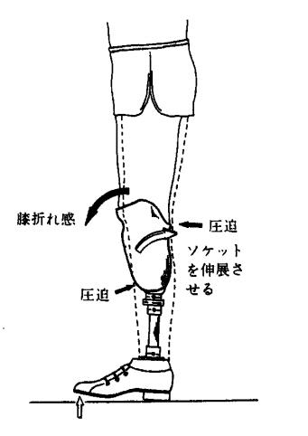 假肢穿戴舒服的三要素：接受腔，对线，康复训练