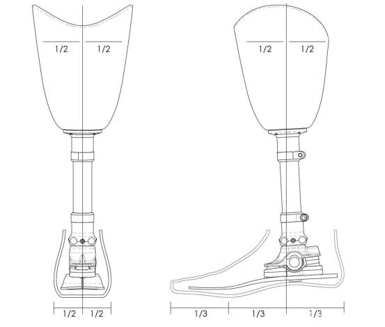 假肢穿戴舒服的三要素：接受腔，对线，康复训练