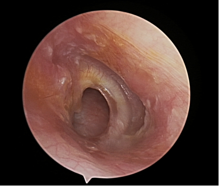 病例分享|耳内镜手术，精准微创治疗耳科疾患