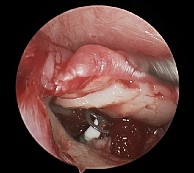 病例分享|耳内镜手术，精准微创治疗耳科疾患