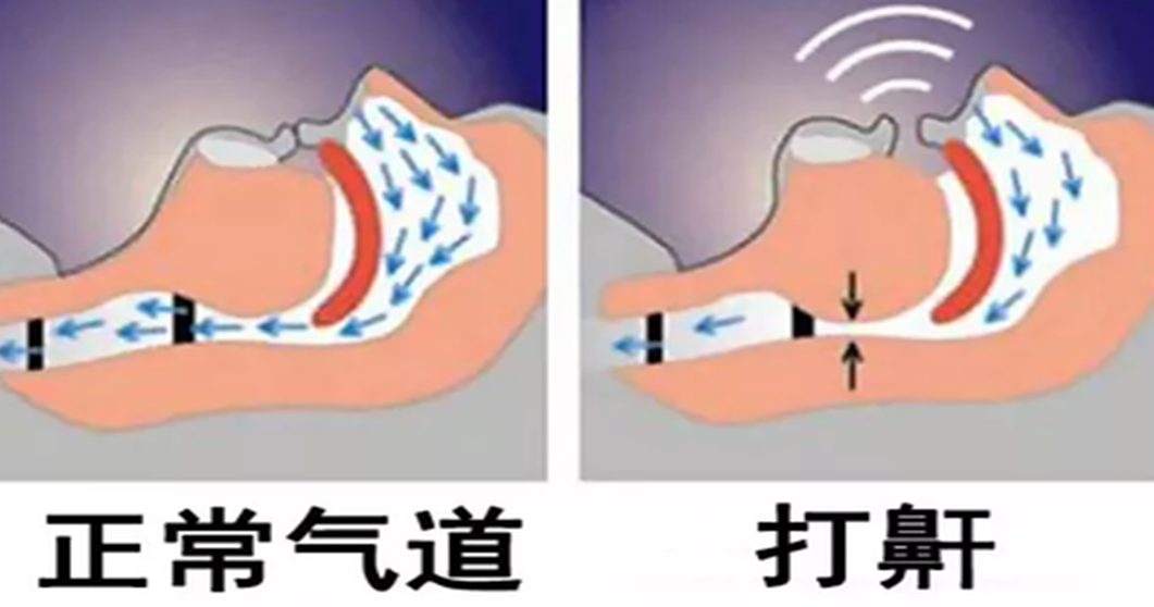 大众科普|打呼噜是睡得香吗？警惕阻塞性睡眠呼吸暂停低通气综合征！