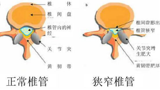 大众科普|腰腿疼痛，小心腰椎管狭窄！