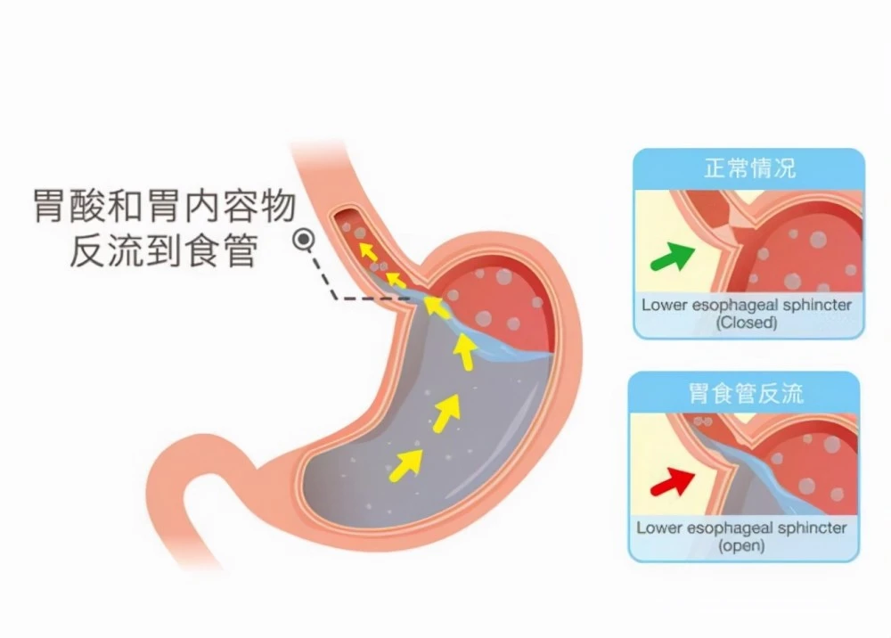 护理园地|日常如何有效护理胃食管反流？