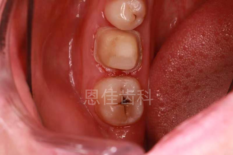 【用户分享】数字化椅旁单冠即刻修复