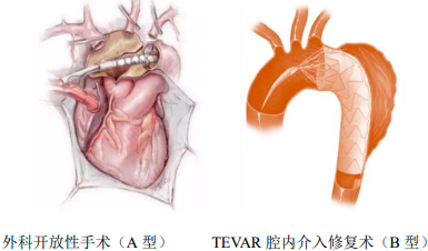 2023年中国主动脉介入治疗医疗器械行业市场规模发展现状分析及未来市场发展空间研究预测