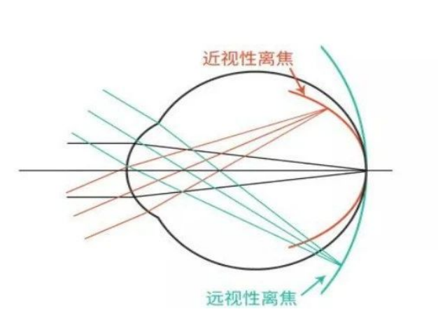 大众科普|OK镜近视防控 大众科普|OK镜近视防控