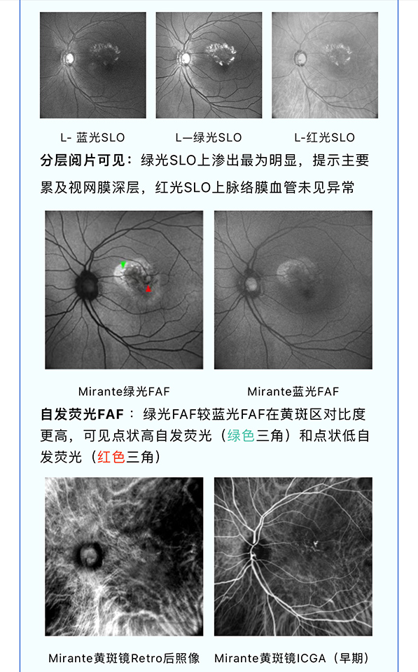 【全彩病例分享】——左眼湿性年龄相关性黄斑变性