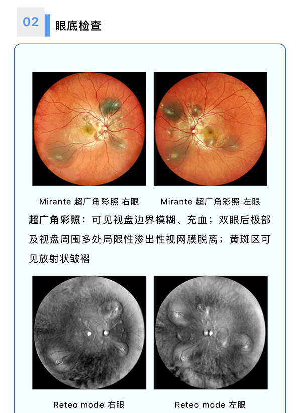 【全彩病例分享】——双眼Vogt-小柳-原田病继发渗出性视网膜脱离