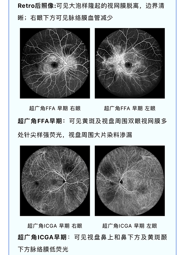 【全彩病例分享】——双眼Vogt-小柳-原田病继发渗出性视网膜脱离