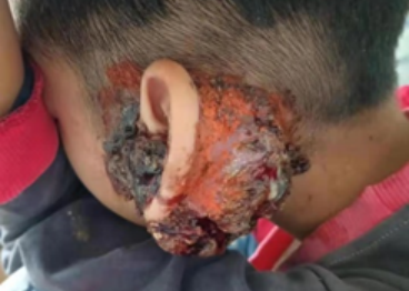 病例分享|为湖南8岁儿童消除拳头般大的左耳肉瘤， 广州医生仅用一招就消除