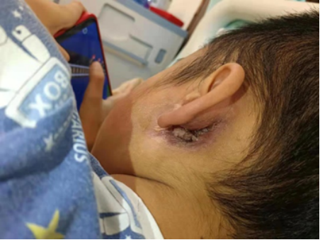 病例分享|为湖南8岁儿童消除拳头般大的左耳肉瘤， 广州医生仅用一招就消除